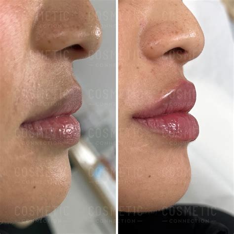 Lip Filler Kamloops at Corazon Stafford blog