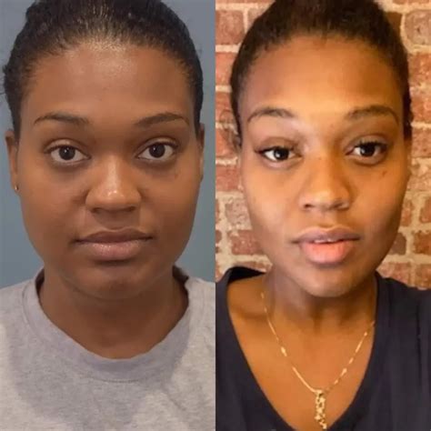 Buccal Fat Removal Before and After - Before After Journey