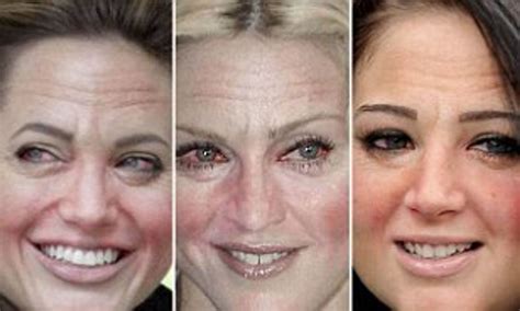 Alcoholic Face Swelling