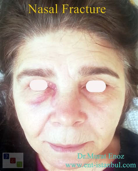 Stabilization Of Nasal Fracture