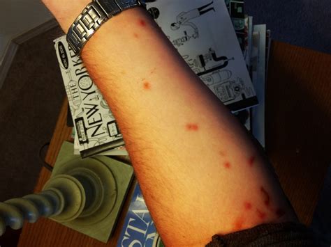 Carpet Beetles Bites On Humans at Evie Peter blog