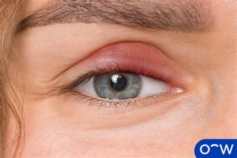 Eye Allergies: Types, Causes, Symptoms, and Treatments