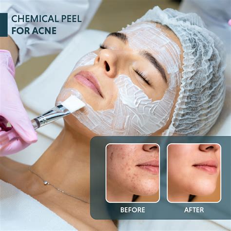 Chemical Peels For Acne: How It Works, Types, Benefits & Side Effects