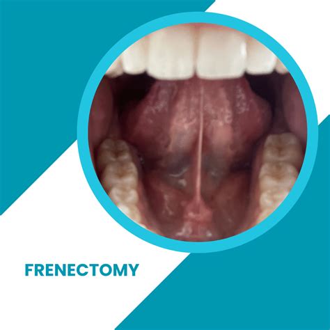 Frenectomy - What is it and Why it's Necessary