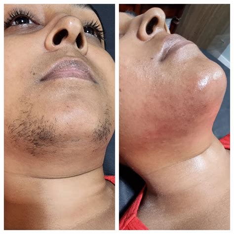 Pcos Facial Hair