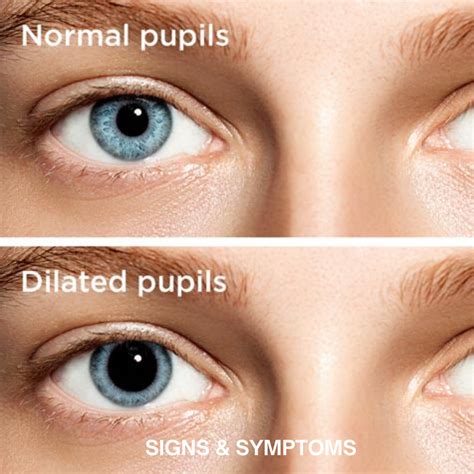 Understanding Dilated Pupils: Causes, Symptoms, and Treatment