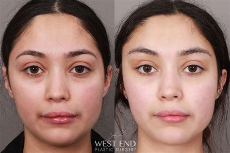 Brow Lift And Zygoma Surgery – Midface Anatomy, Aging, and Aesthetic Analysis – NEMXDG