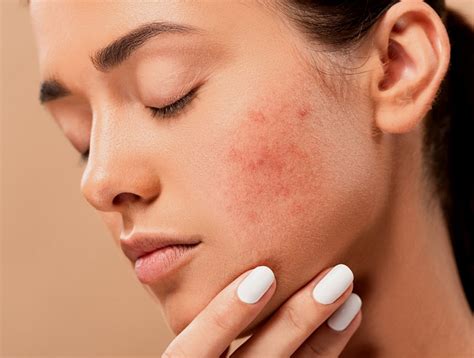 7 Ways to Get Rid of Stress Acne - The Acne Nutritionist Maria Marlowe