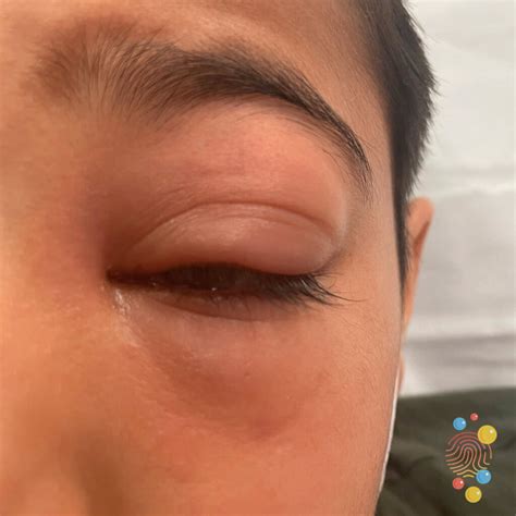 Eye Orbital Cellulitis