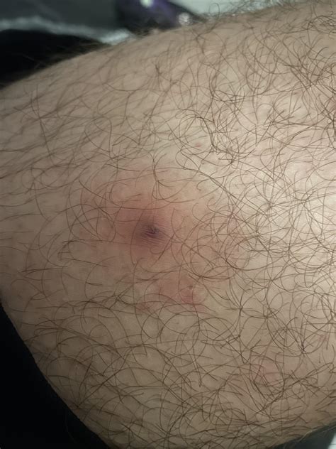 Bump On Inner Thigh When Is It Time To Have Skin Lumps Examined?