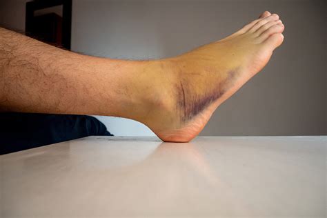 Fractured Ankle Bruising
