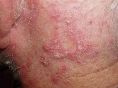 SKIN DISEASE TYPES: Seborrheic Dermatitis
