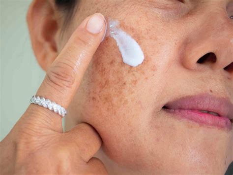 What You Need To Know About Melasma | Victorian Dermal Institute