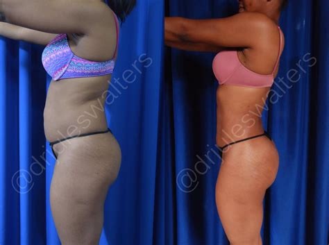 Before And After Brazilian Butt Lift Pics