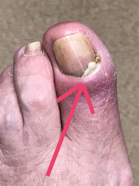 Nail Bed Infection Pictures at Katie Butters blog