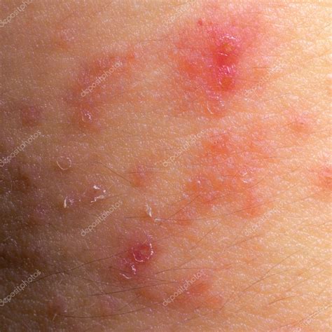 eccema dermatitis atópica síntomas textura de la piel 2022