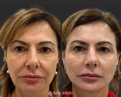 PDO Thread Lifting - Before and After Results at Skinly Aesthetics