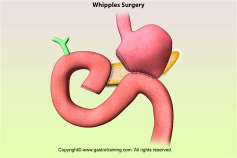 Gastroenterology Education and CPD for trainees and specialists » Chronic pancreatitis