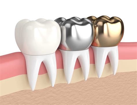 Complete Dental Crown Guide: Cost, Procedures, And Types