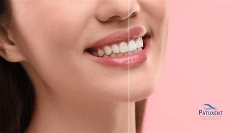 11 Causes of Tooth Discoloration