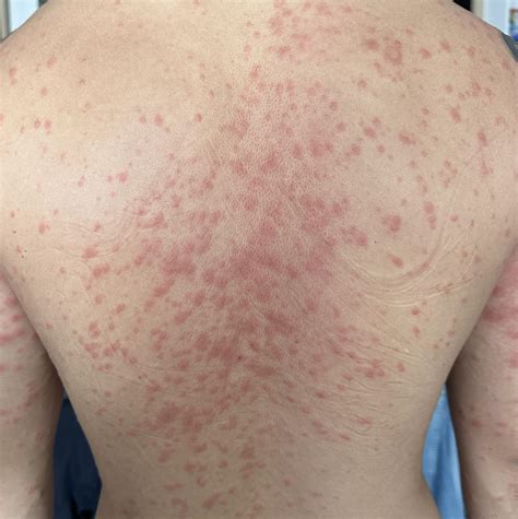 Pityriasis Rosea Christmas Tree