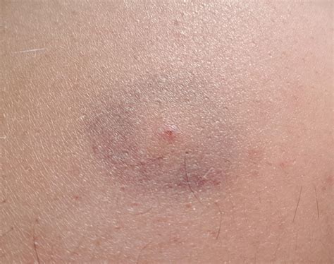 Circle Bruise With Dot In Middle at Cornelius Davis blog