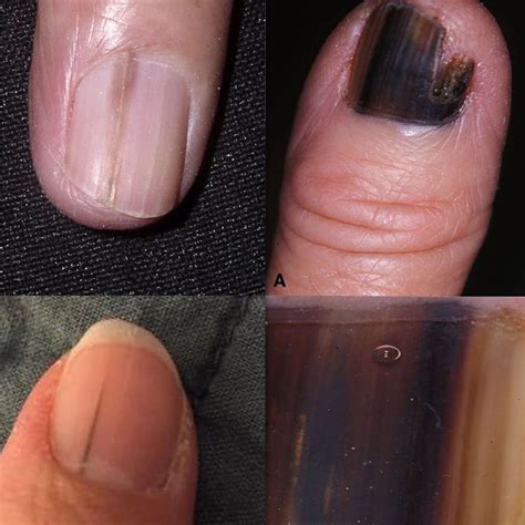 What Causes Black Spots Under Toenail at Helene Whetsel blog