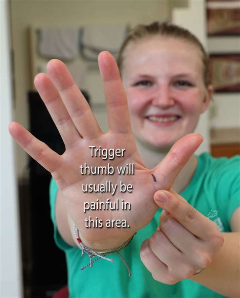 What Is Trigger Finger Thumb: Trigger Fingers – YQTI