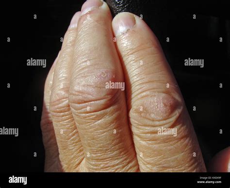 Too dry human skin cracked on finger joints close up Stock Photo - Alamy
