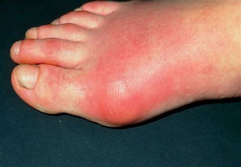 Gout causes, prevention, signs, symptoms, diagnosis & treatment