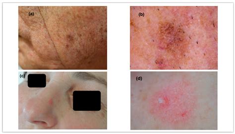 Dermoscopy of Actinic Keratosis: Is There a True Differentiation between Non-Pigmented and ...