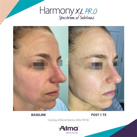 Rosacea Treatment Before and Afters | Dermatology