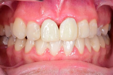 Receding Gums: Causes, Symptoms, & Gum Recession Treatment