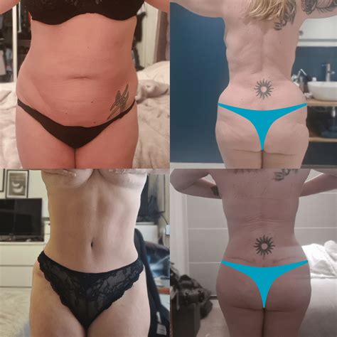 Hip Augmentation With Fat Grafting