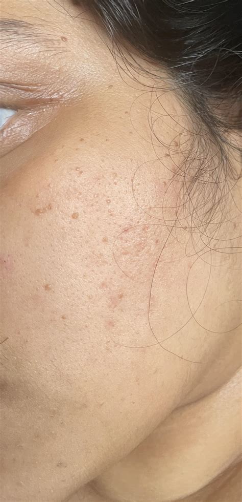 How To Remove Warts On Face 5 Reasons Why You Shouldn't Remove Warts