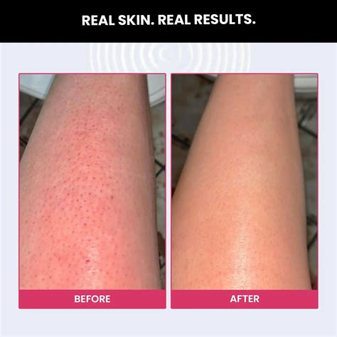 Buy Bumps Eraser Exfoliating Scrub for KP Skin & Strawberry Legs