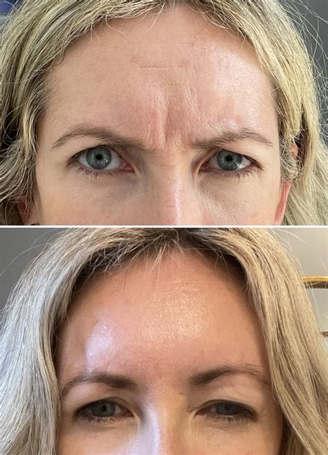 Botox Before & After | Oakville, ON | Nurse Jacklyn