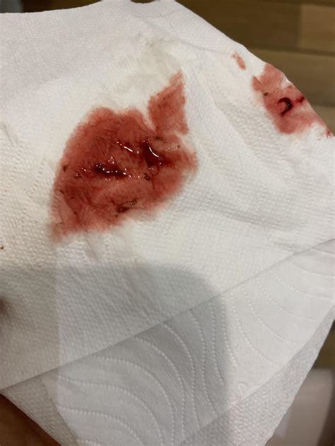 Pregnancy Implantation Bleeding Pictures