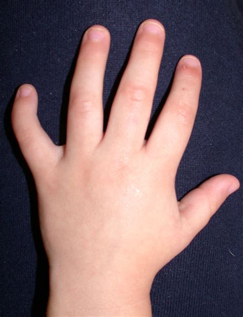 Clinodactyly | Congenital Hand and Arm Differences | Washington ...