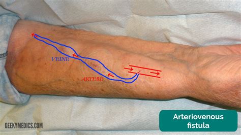 What Is Av Fistula For Dialysis at Harold Raines blog