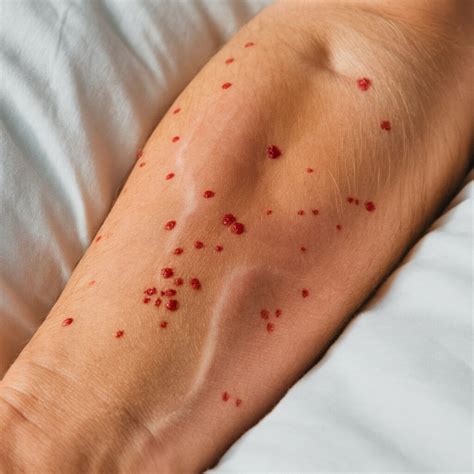 Picaduras de Chinches: Identificación, Efectos y Prevención