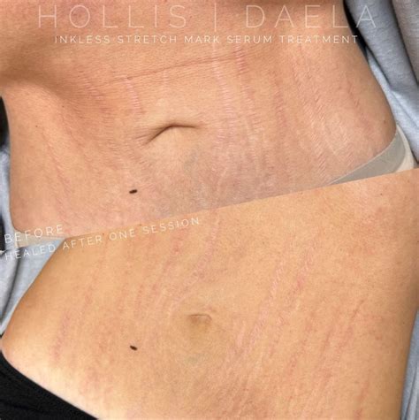 Stretch Mark Camouflage Treatments In Scottsdale | DAELA Cosmetic Tattoo