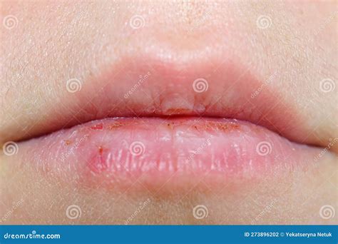 Chapped Lips Bumps