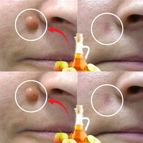 Apple Cider Vinegar: A Natural Solution for Removing Warts in 24 Hours ...