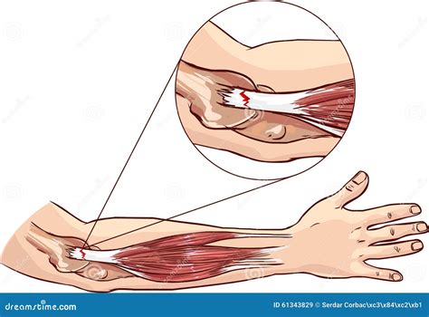 Tennis Elbow - Tear In The Common Extensor Tendon Of The Arm Cartoon Vector | CartoonDealer.com ...