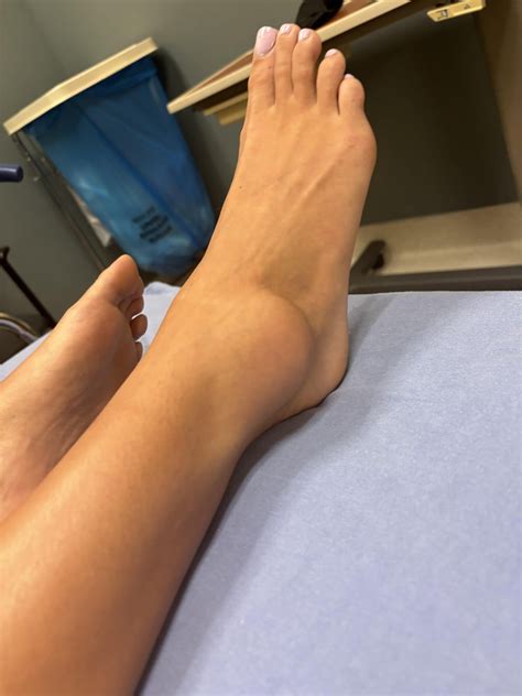 Rolled ankle : r/InjuryRecovery