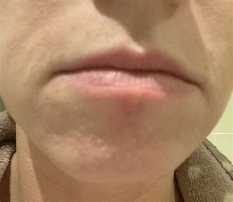 skin colored bumps on chin treatment – Hypertrophic (raised) scars – Acne.org Forum