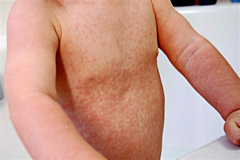 Top Viral Rashes in Babies: Symptoms, Causes, and When to Seek Help