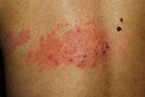 How to Tell Shingles From Poison Ivy