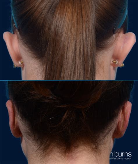 Otoplasty- Ear Pinning- Dallas, TX- Dr. John L. Burns, MD – Dr John Burns